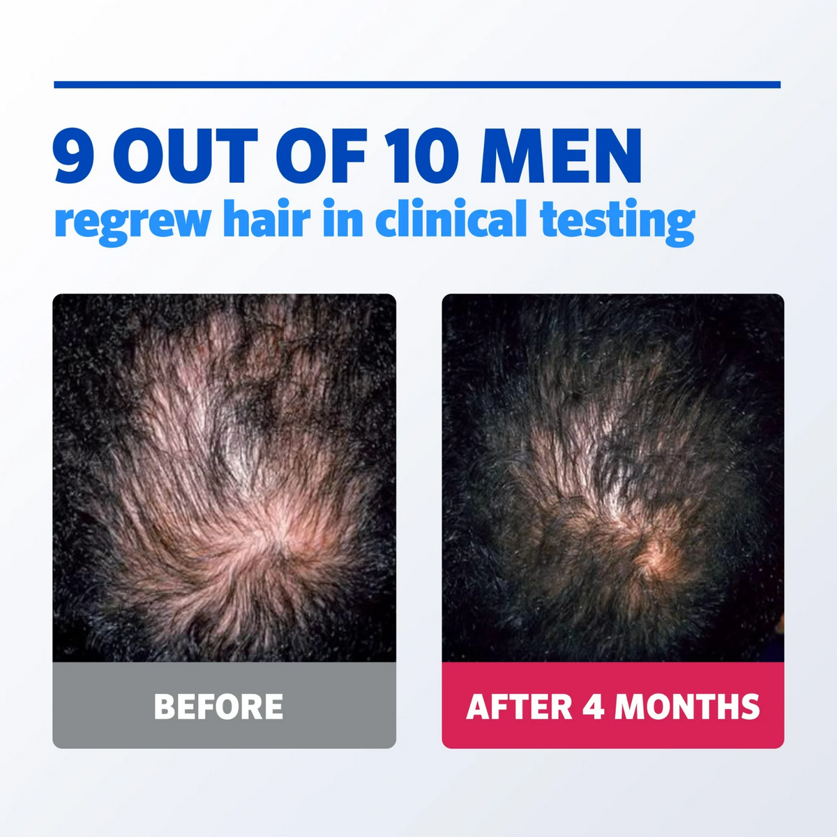 Kirkland Signature 5% Minoxidil Hair Regrowth Treatment for Men 60mL