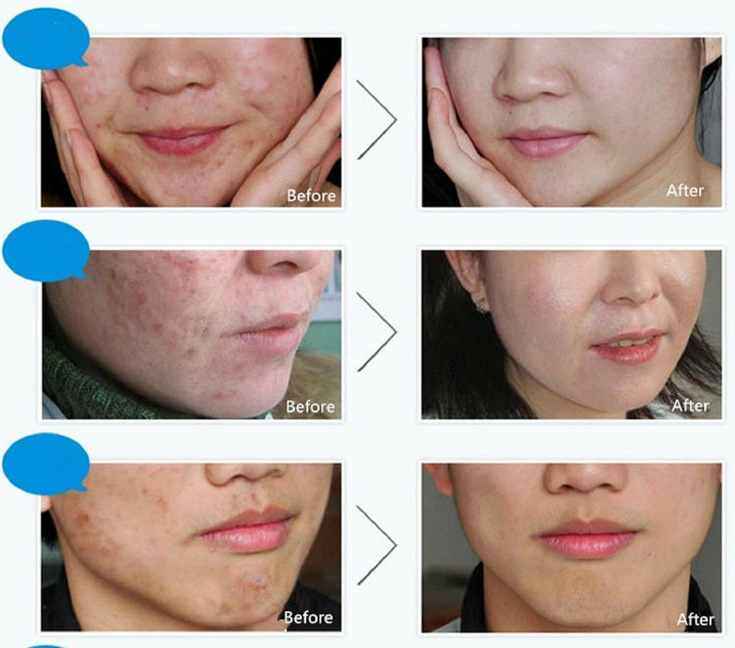 BIOAQUA Acne Scar Removal Cream – Pore Minimizing Brightening Facial Treatment | Free ShippingCrema De Acné Removedor De Cicatrices Poros Blanqueadora Piel Facial Tratamiento