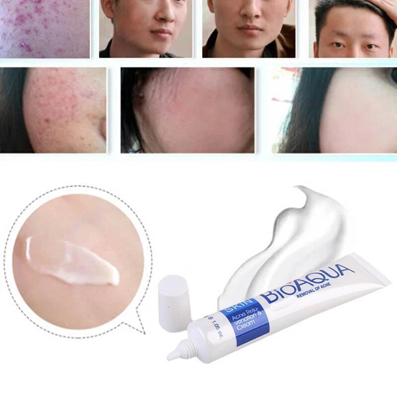 BIOAQUA Acne Scar Removal Cream – Pore Minimizing Brightening Facial Treatment | Free ShippingCrema De Acné Removedor De Cicatrices Poros Blanqueadora Piel Facial Tratamiento